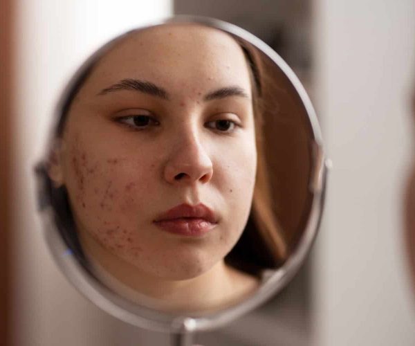 ערכת טיפול טבעית לאקנה